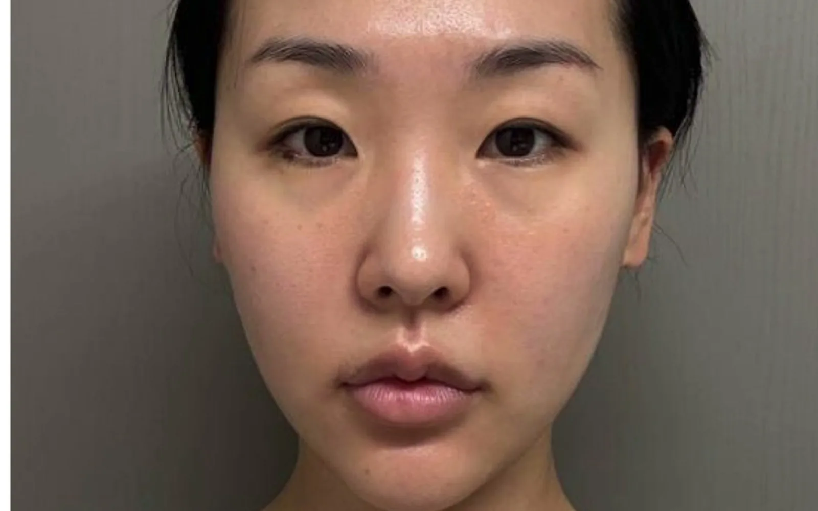 리프팅 시술을 반복해도 효과가 없는 진짜 이유