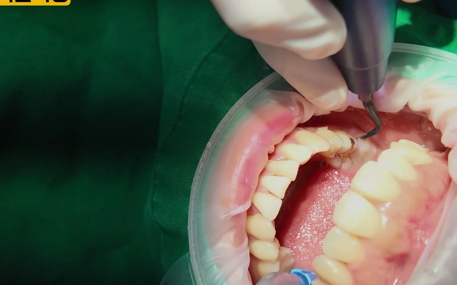 양치해도 남는 치아 표면 찌꺼기, 치석 되기 전 관리법