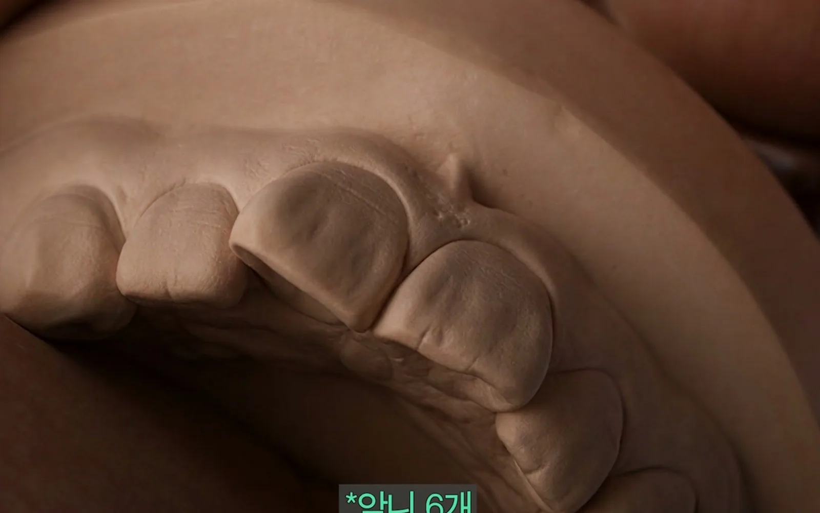 깨진 앞니 무조건 씌우지 마라, 레진으로 끝내는 조건