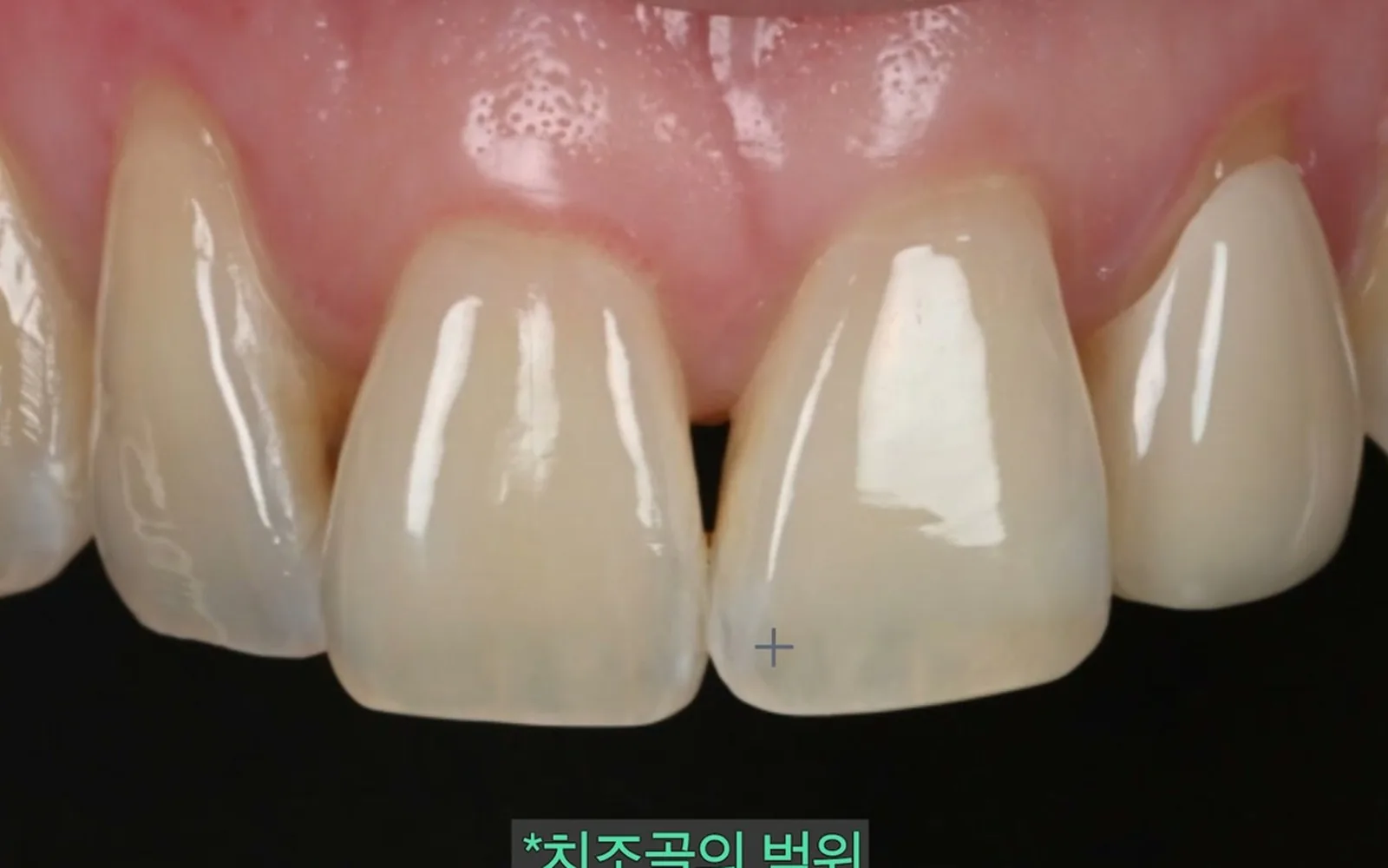 점점 길어지는 치아, 내려앉은 잇몸 되돌릴 수 있을까?