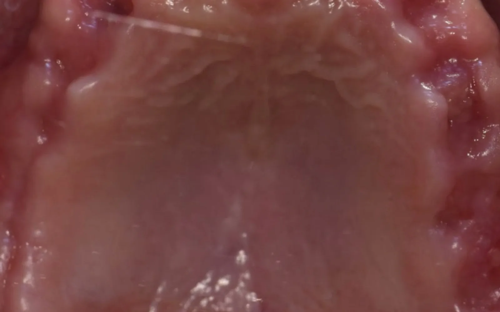 염증 심한 치아, 뽑자마자 임플란트 심어도 되나