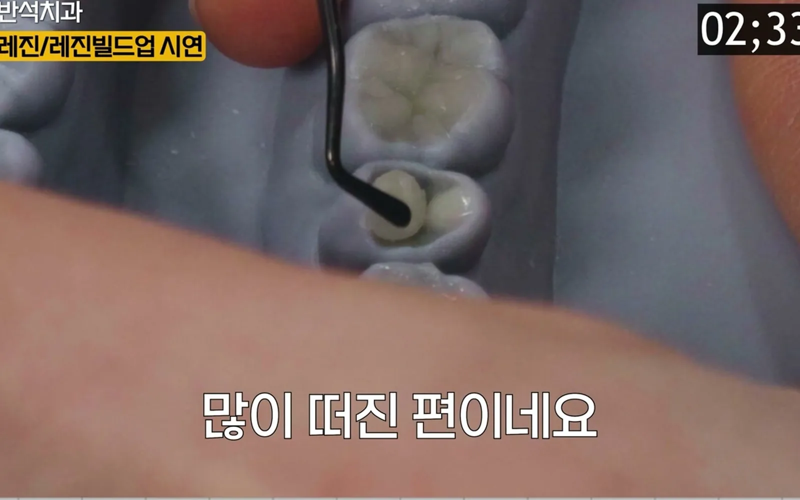 치아 덜 깎으려 금니 선택? 오히려 구멍 날 수 있다