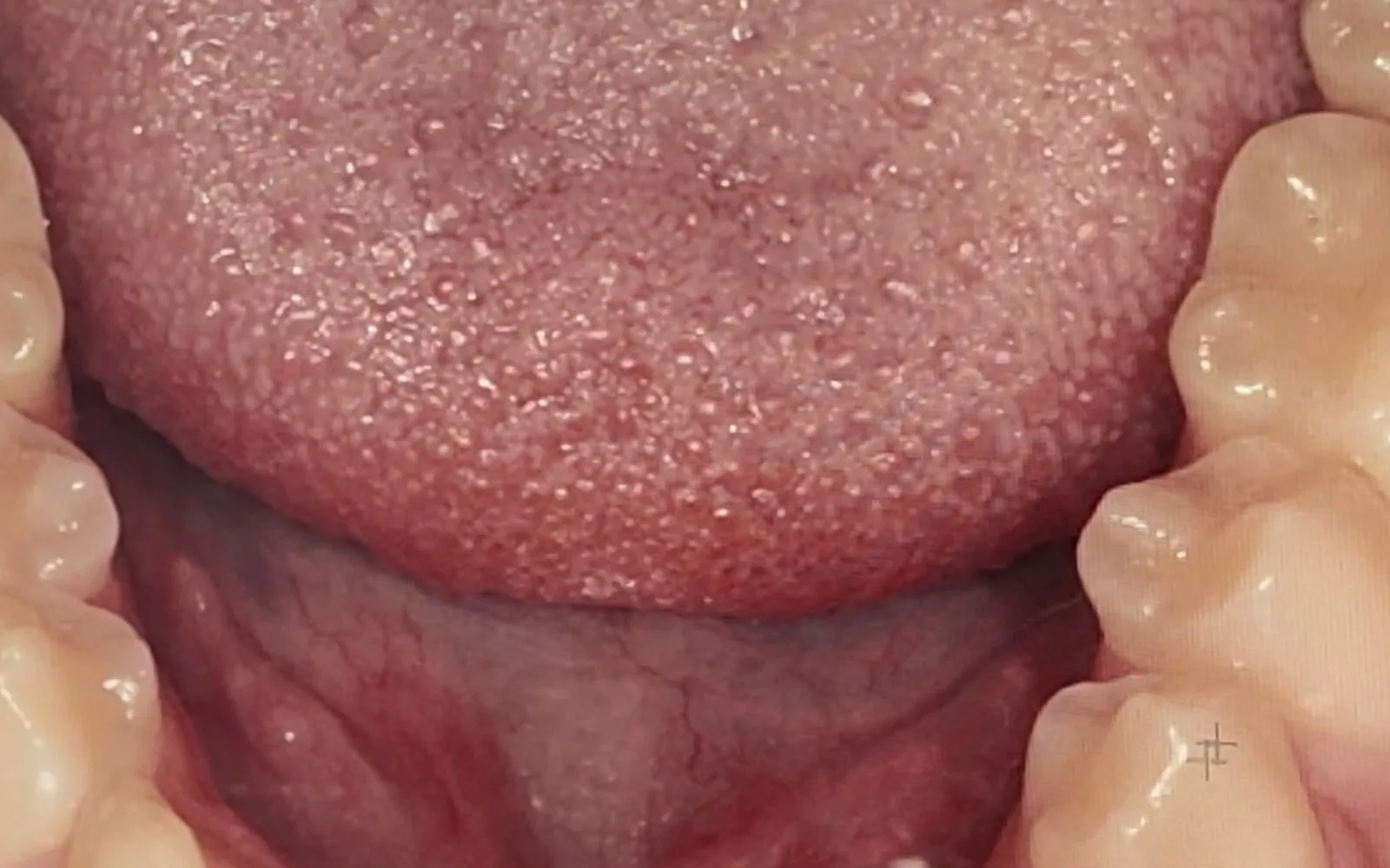 까맣게 변한 치아, 무조건 깎아내야 할까?