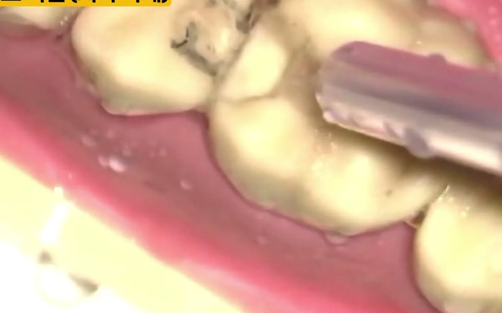 치아 사이 충치, 윗면보다 신경까지 빨리 뚫리는 이유