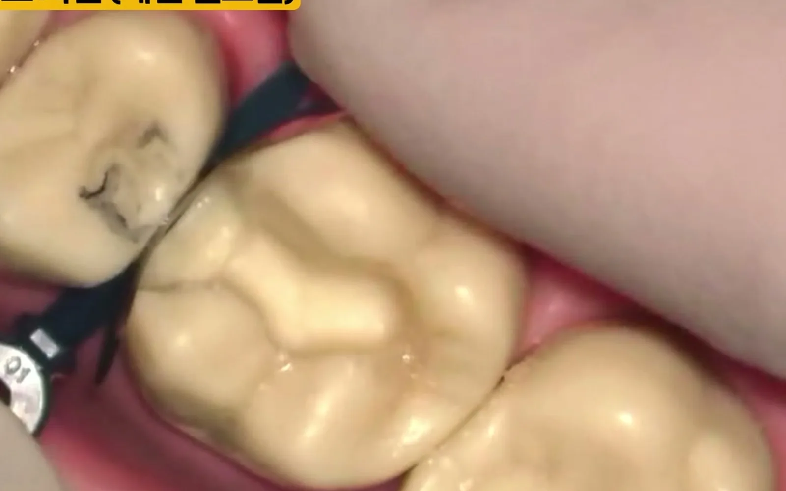치아 사이 충치, 윗면보다 신경까지 빨리 뚫리는 이유