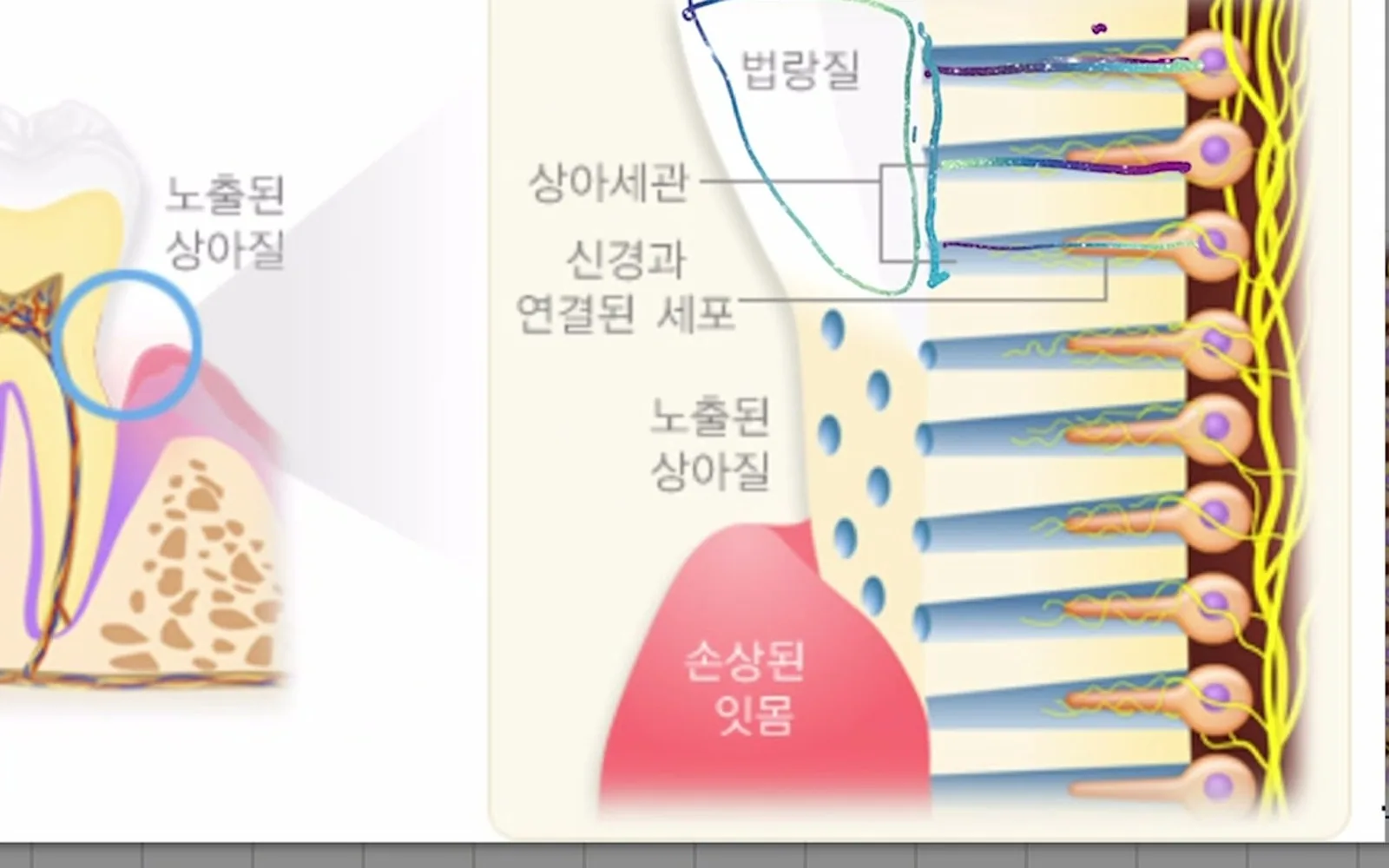 찬물 마실 때 시린 치아, 충치가 원인이 아닐 수 있다
