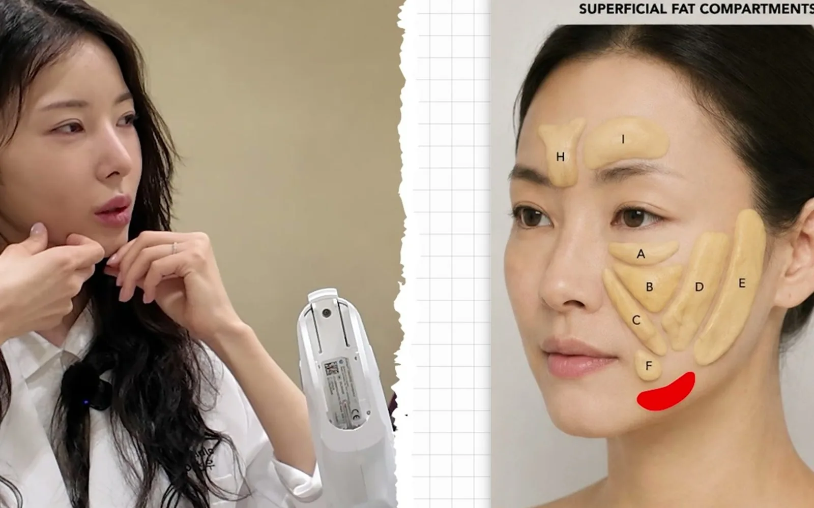 얼굴 작아지려 맞은 턱보톡스, 오히려 네모난 얼굴 만드는 이유