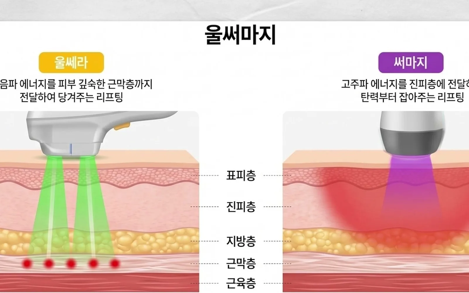 웨딩 촬영 앞둔 예비부부, 시술은 2개월 전이 적기다