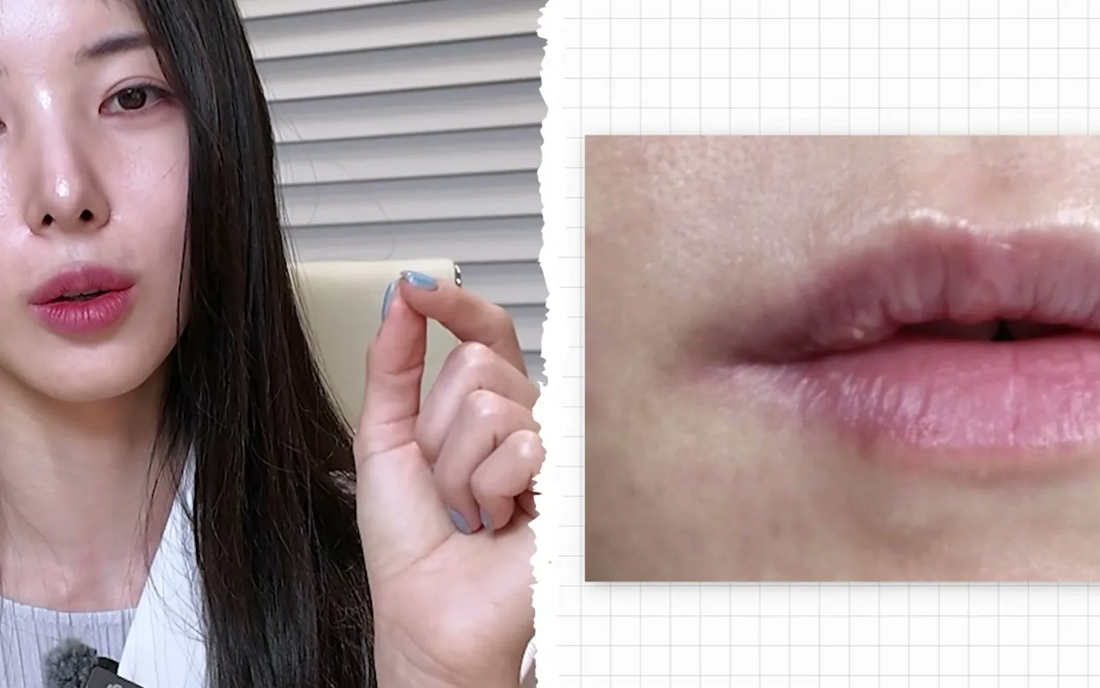 얇은 입술에 무작정 필러 넣으면 얼굴이 더 커 보이는 이유