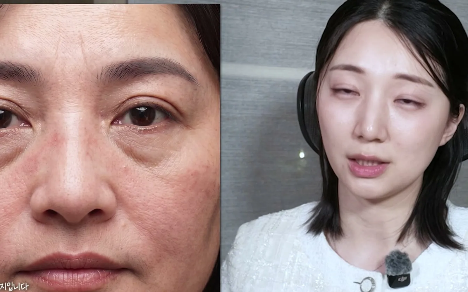 눈밑 꺼짐에 필러부터? 시술 순서 틀리면 생기는 일