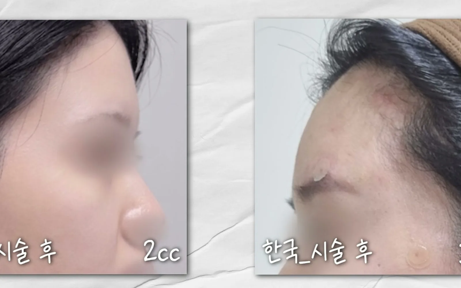 푹 꺼진 이마 채우려다 '전구알' 된다? 예쁜 이마의 조건