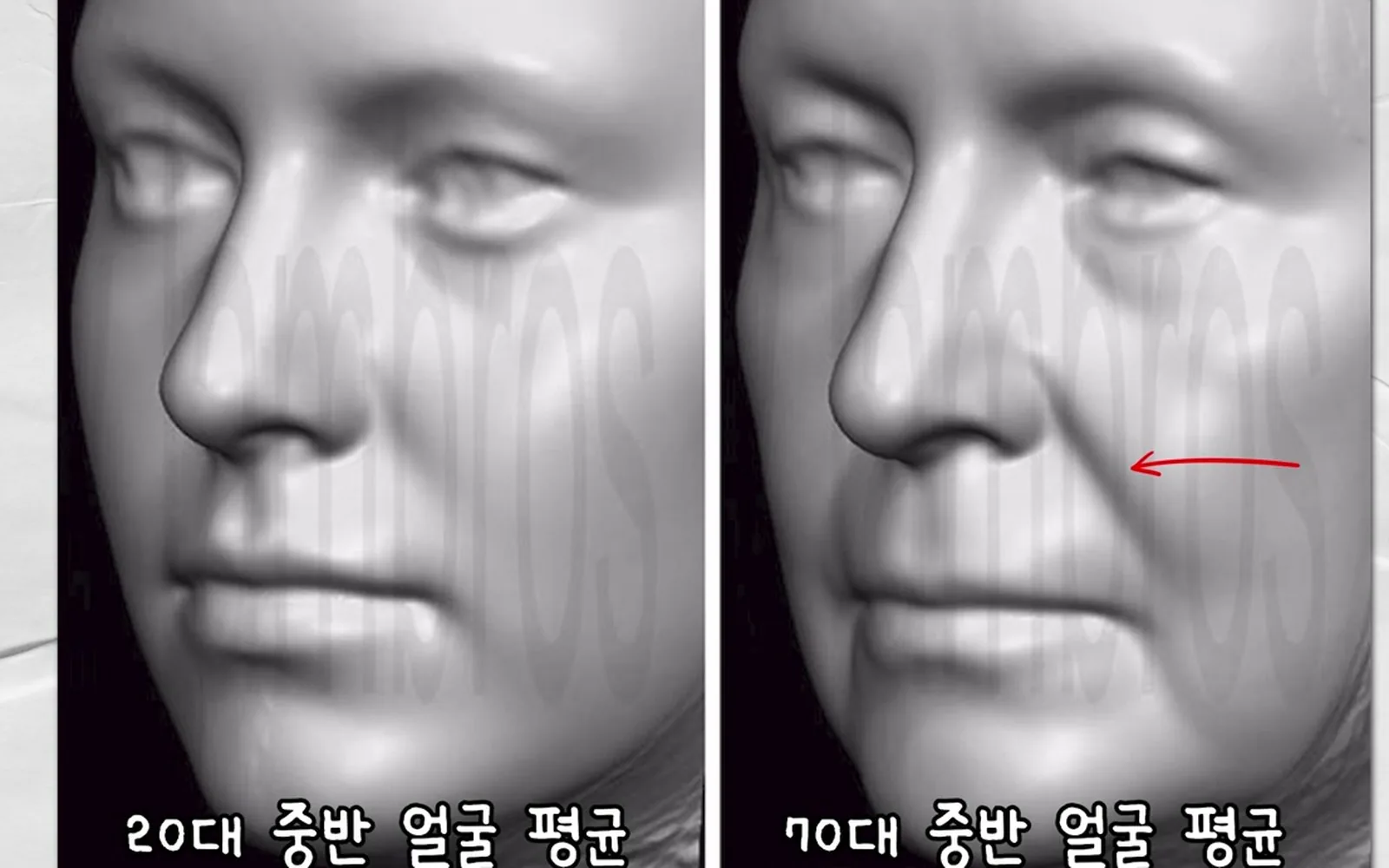화장 끼는 팔자주름, 원인은 피부 처짐 아닌 뼈에 있다