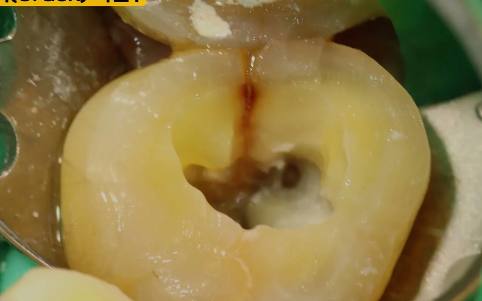 금 간 치아 통증, 무조건 발치하지 않아도 되는 이유