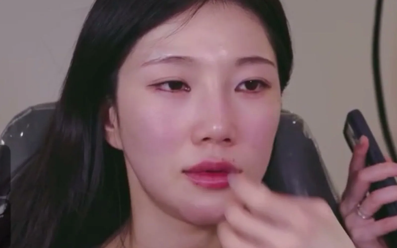 입꼬리 처졌다고 필러만 꽉 채우면 생기는 일