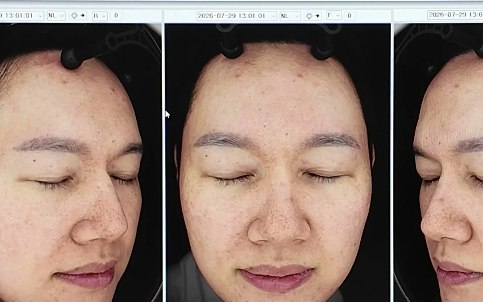 여름휴가 후 올라온 잡티, 당장 레이저 받으면 안 되는 이유